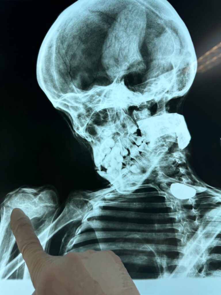 X-ray of nazca mummy